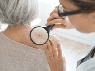 Mohs surgery explained: What to expect and why it works