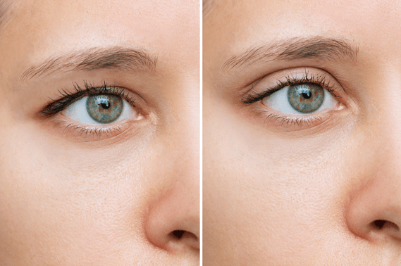 drooping upper eyelid before and after blepharoplasty