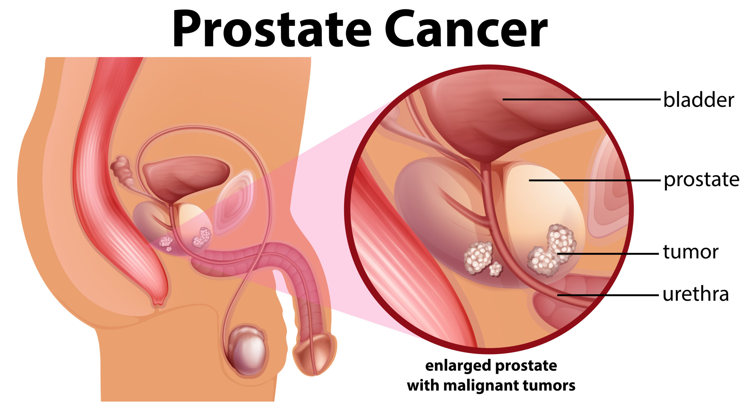 Prostate cancer diagram
